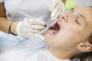Cause e cura della parodontosi